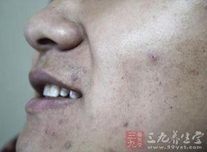 拨粉刺视频,拨粉刺视频教学